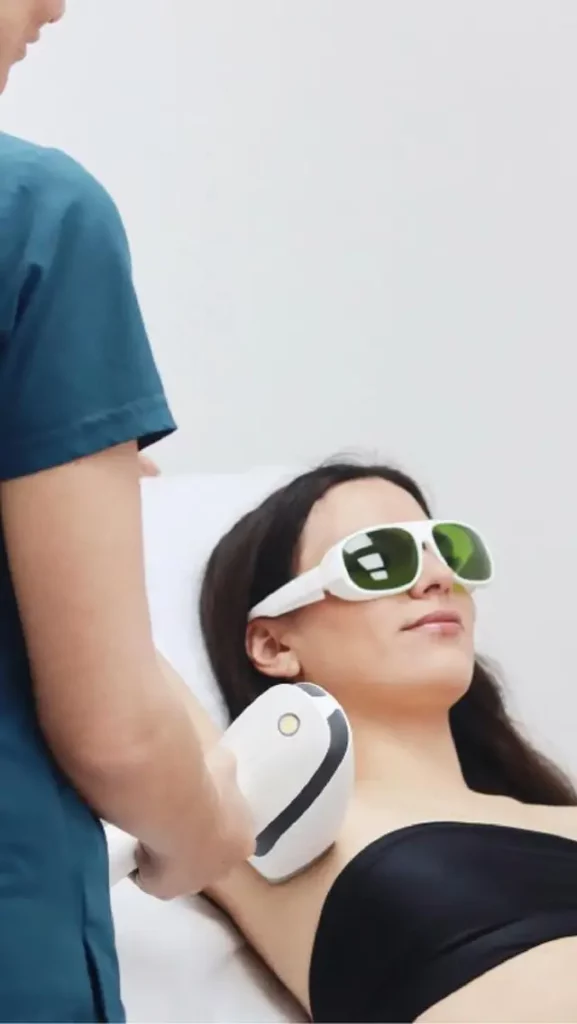 ÉPILATION LASER